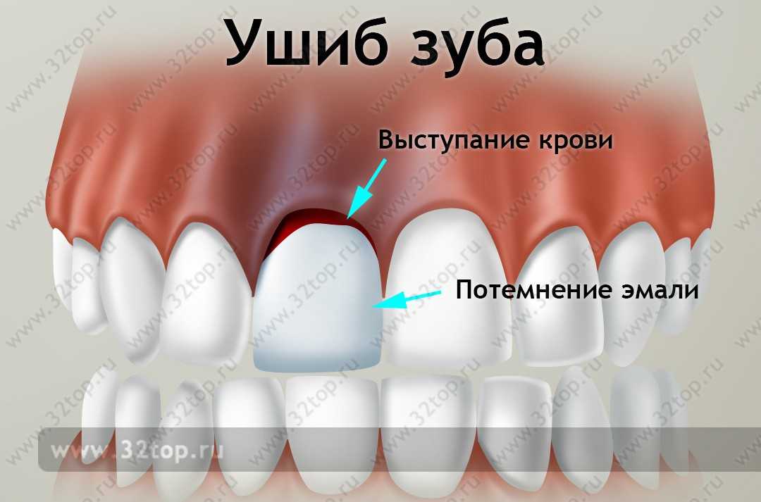 Травма зубов у детей - Ушиб, Вывих, Перелом - Что делать?