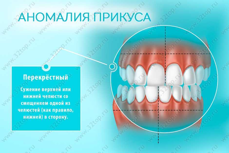 Разновидности полу физических видов прикуса по характеру перекрытия