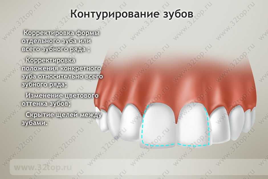 Контурирование зубов: разновидности, показания, ход процедуры