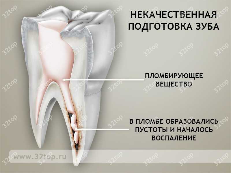 Почему сильно болит зуб после удаления нерва?