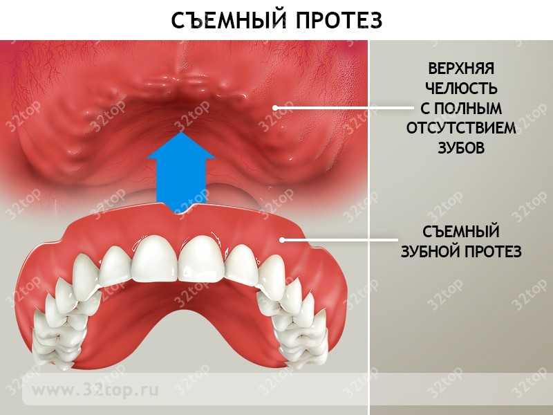 Трещина в зубном протезе ремонт дома