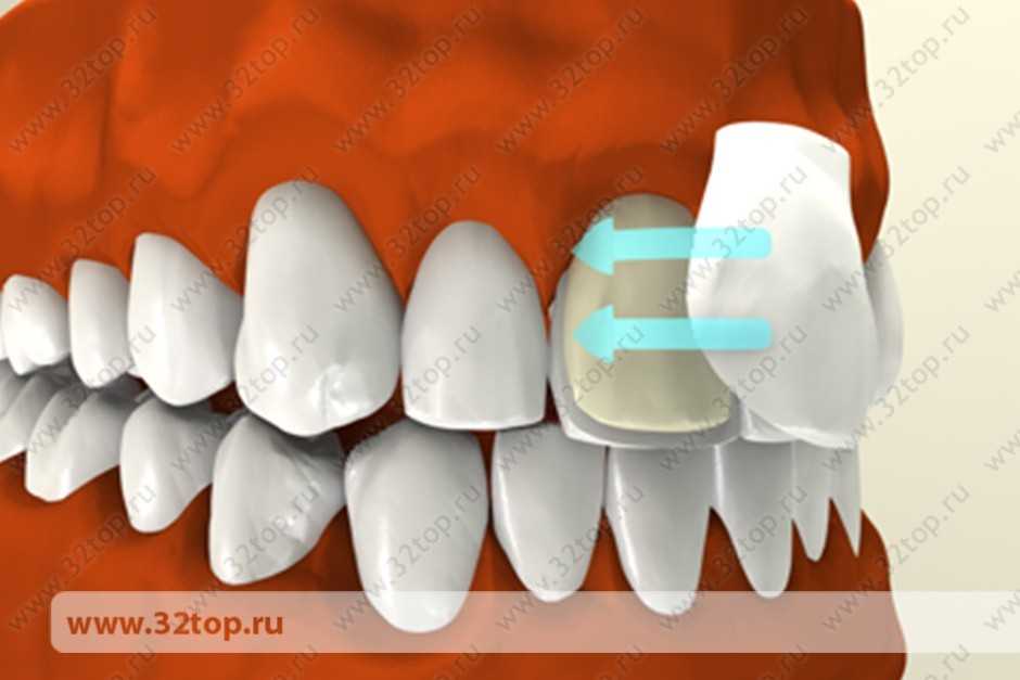 Покрытие зуба защитным лаком Томск Ялтинская Протезирование на имплантах Томск Сахалинский