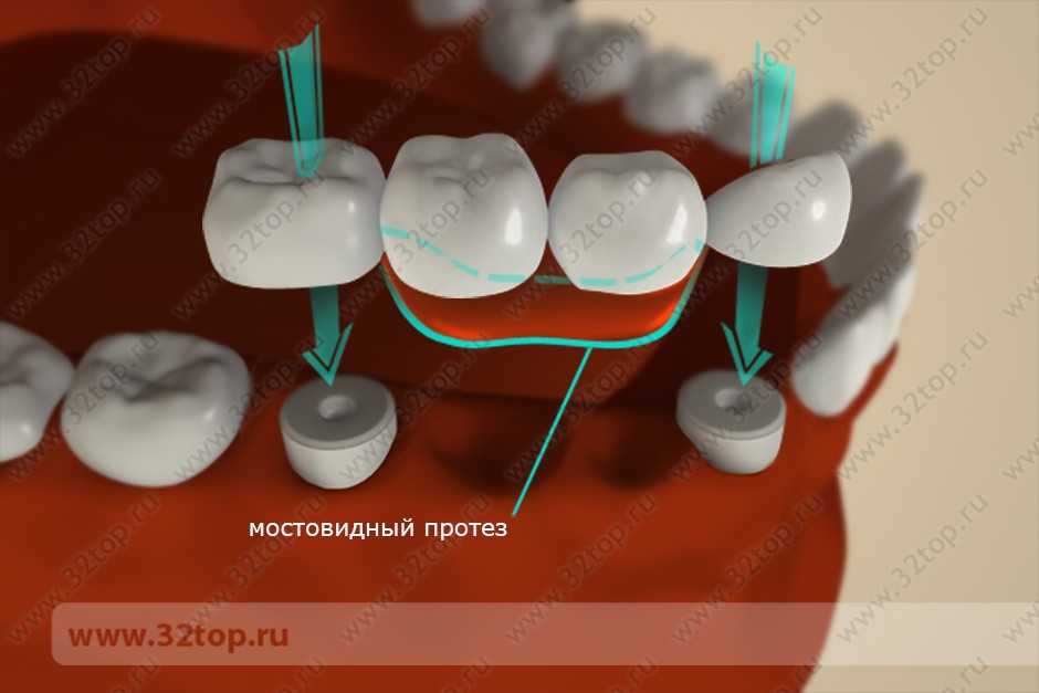 Мышьяк в зубе. Применение мышьяка в современной стоматологии.